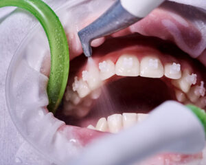 Zähne eines Patienten mit fester Zahnspange werden gereinigt