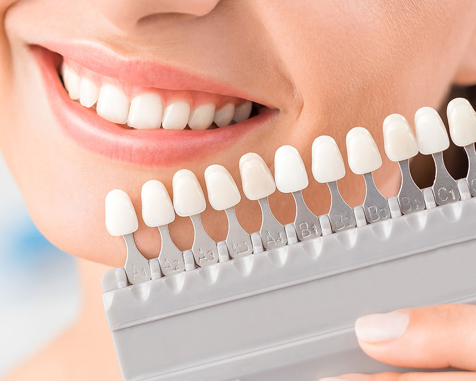 Eine Frau lacht und die Farbe ihrer Zähne wird anhand von Farbproben überprüft. Für Zahnästhetik besuchen sie uns in München.